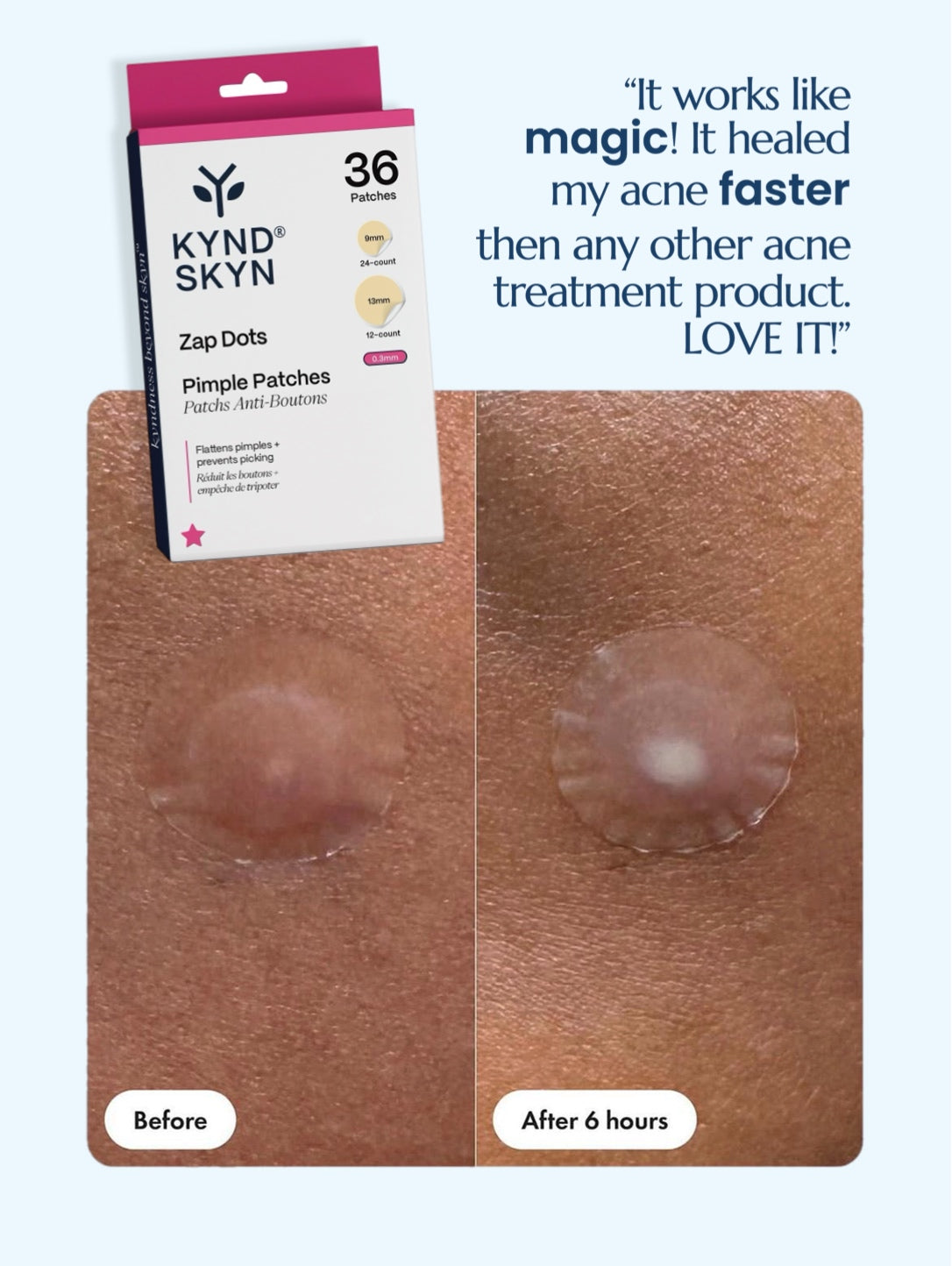 ⭐ ZAP DOTS — Pimple Patches