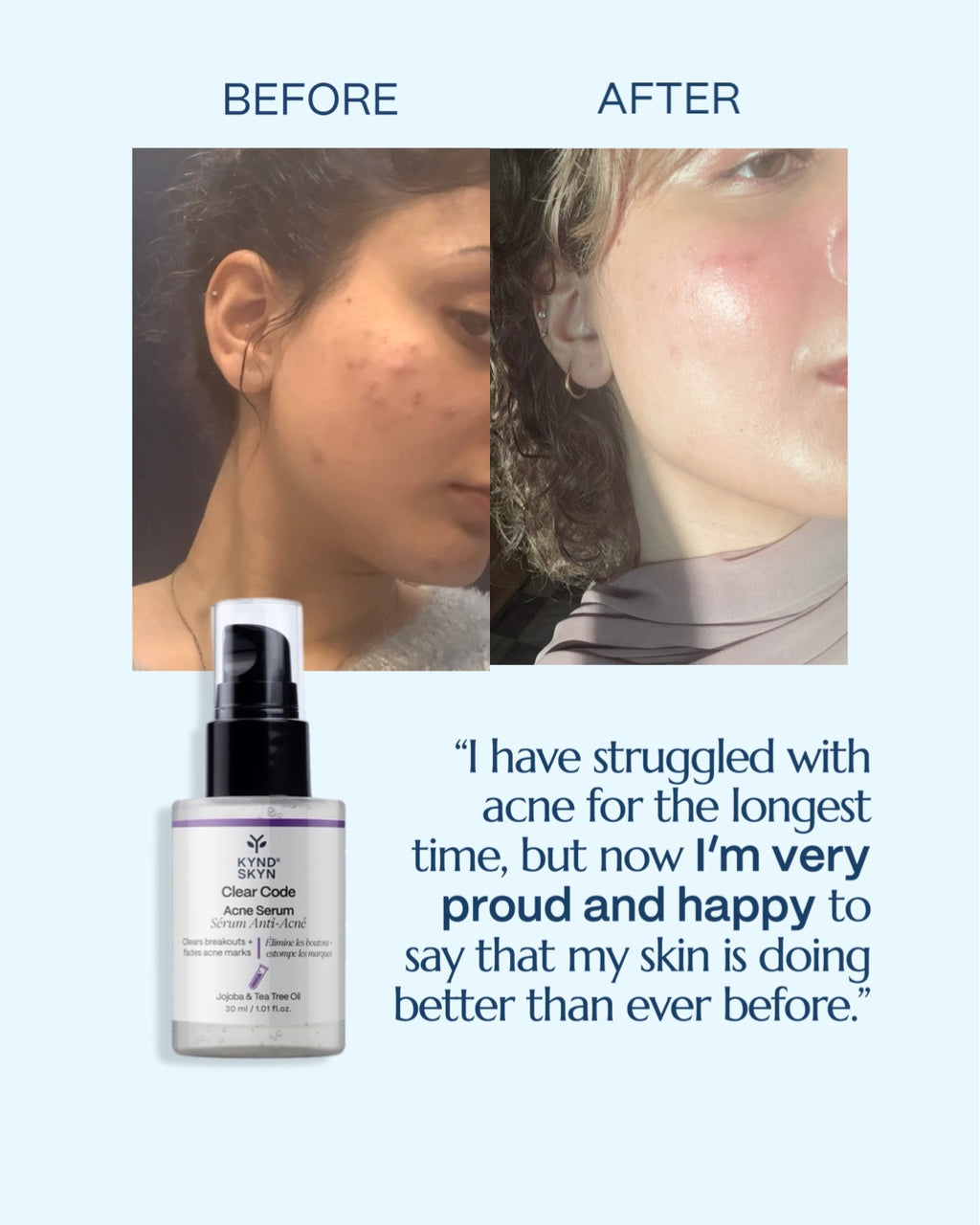 🧪 CLEAR CODE  — Acne Treatment Serum